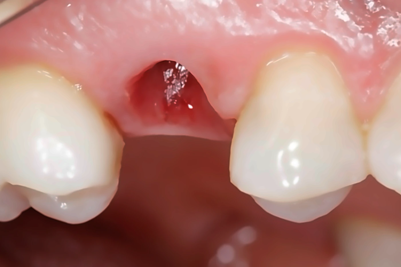 Antes: ausencia de un diente, encía sin pieza dental