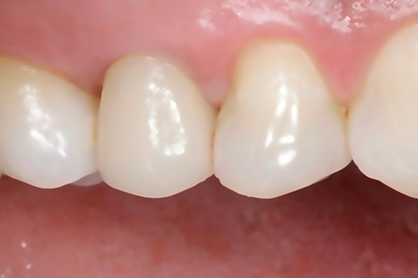 Después: corona del implante integrada con dientes adyacentes, encía sana